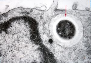 M,43y. | blood - degraded Candida (bone marrow suppression)